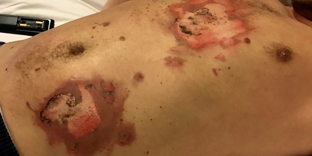 Vape pen explodes in UK man's car, causes third-degree burns: 'It felt like  I was being burnt alive'