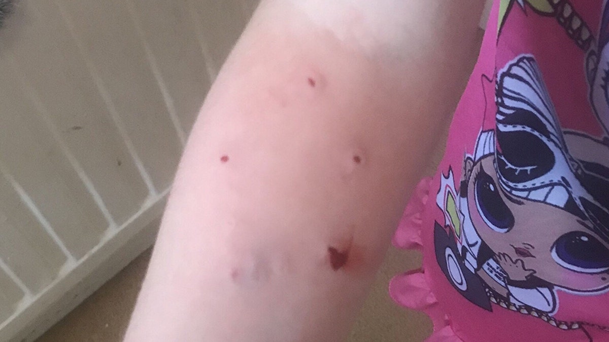 Four out of five puncture wounds became infected due to a bacteria found in the mouths of cats and dogs.
