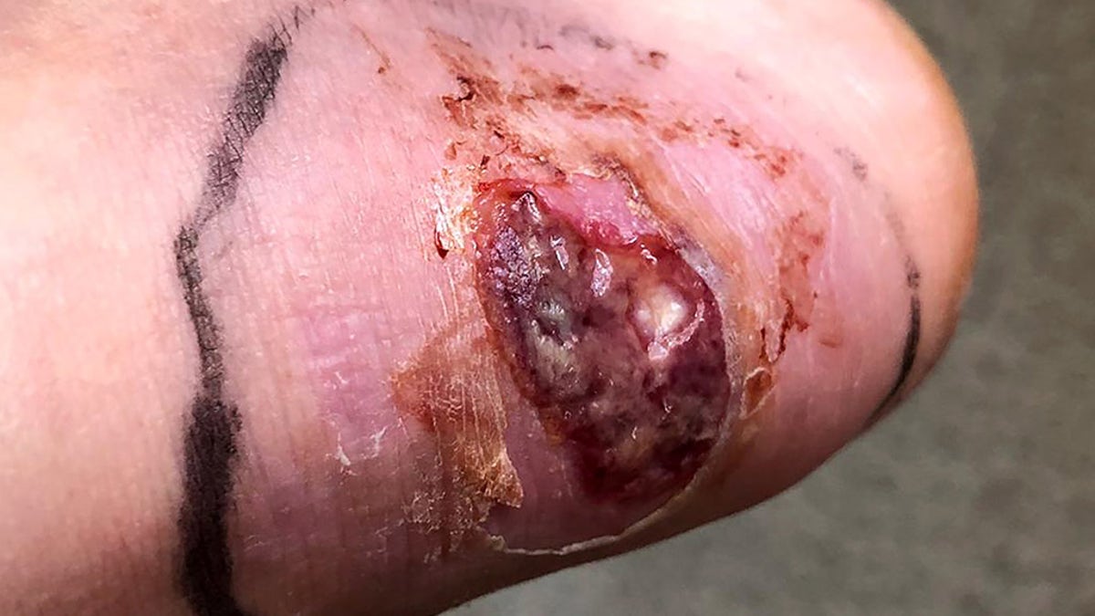 The 23-year-old developed sepsis after a blister formed on her heel, she said.