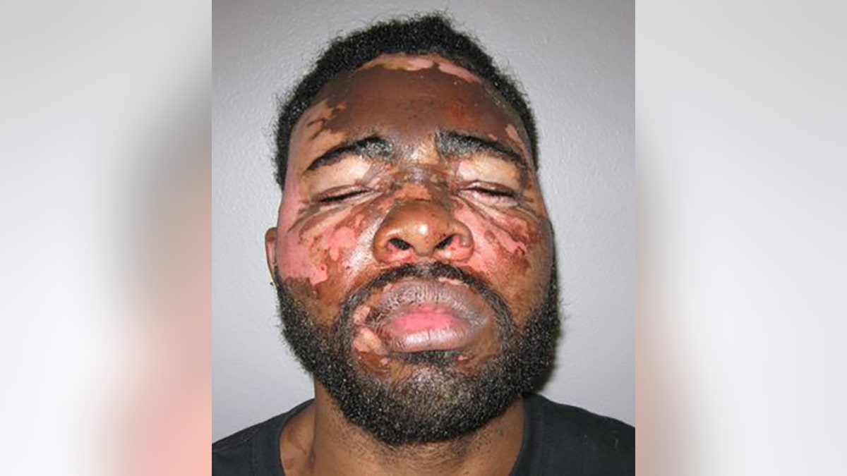 Larondrick Macklin faces two felony counts of domestic violence and burglary after being doused in hot grease after allegedly breaking into a woman's home. 