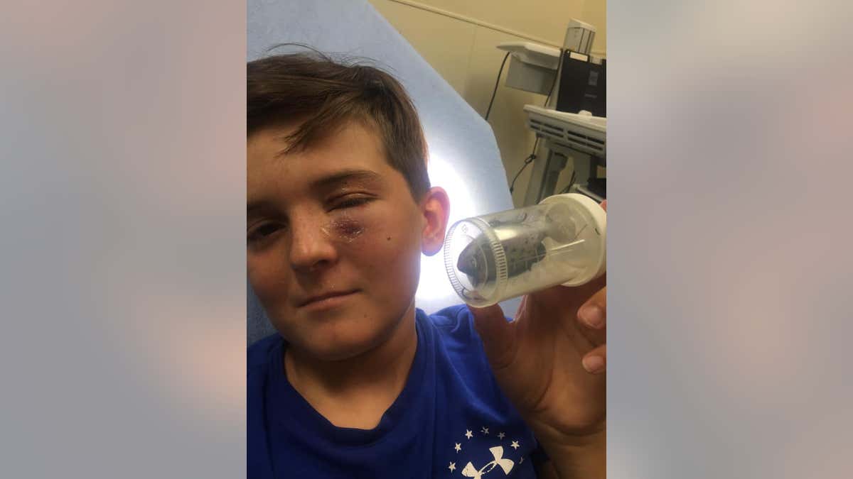 South Carolina Boy, 11, Gets Fish Hook Stuck in His Eye, Calmly