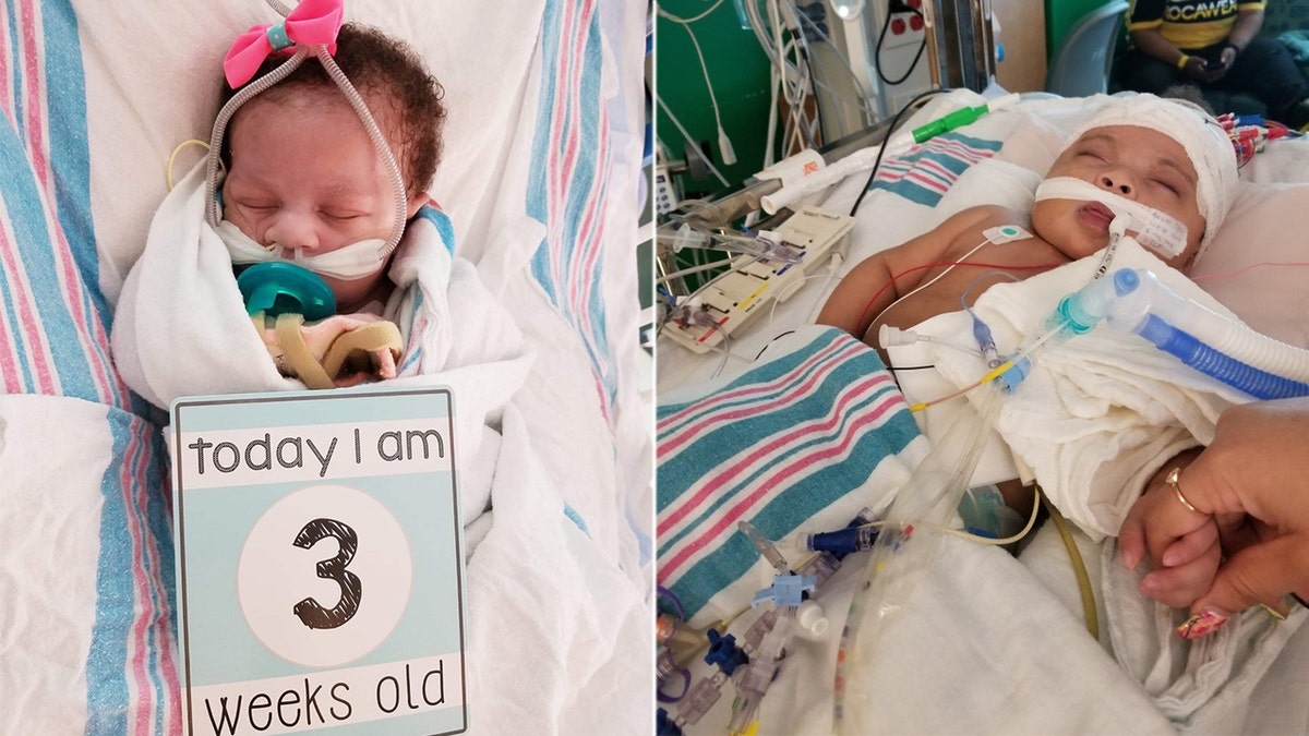 Phoenix Da'Vine, who is set to turn 1 on August 25, was born with a major heart defect known as Double Outlet Right Ventricle.
