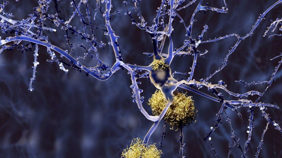 Researchers say the test would analyze the levels of specific amyloid proteins, believed to be an indicator of Alzheimer’s. Together with other factors, including age and genetics, the researchers say their test is 94 percent accurate.