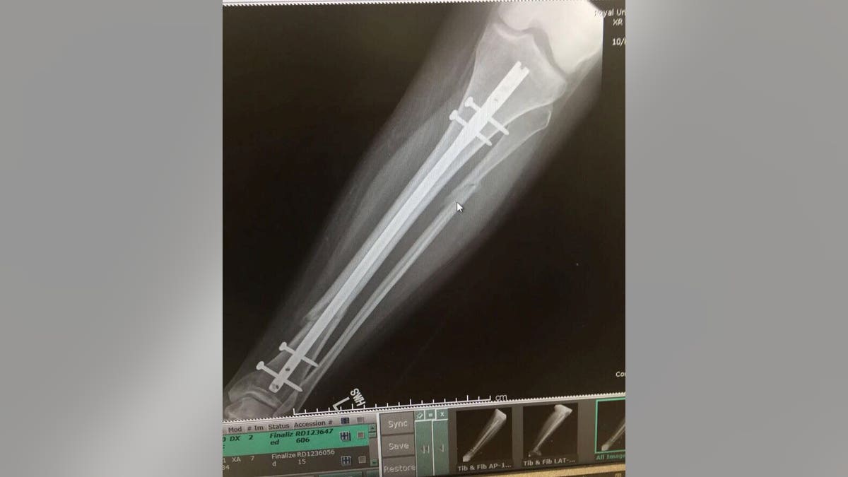 Her leg required extensive surgery to repair. (SWNS)