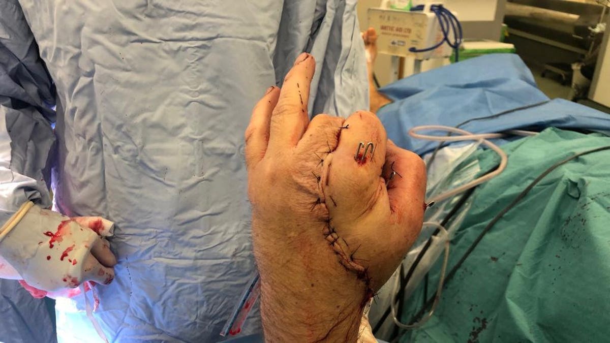 Doctors had to harvest nerve and vein rafts from his foot and forearm but noticed a patch on his palm that was still uncovered. 