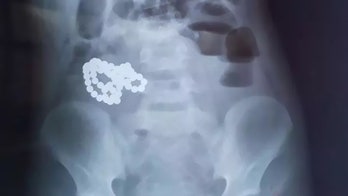 61 magnetic balls pulled from boy's stomach after complaints of intense pain