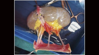 Doctors performing kidney transplant on girl, 9, discover shocking abnormality in donated organ