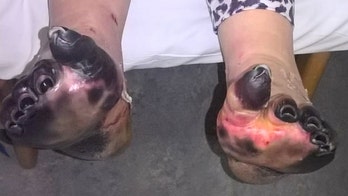 Mom lost toes, nearly died after dismissing sepsis symptoms as common cold