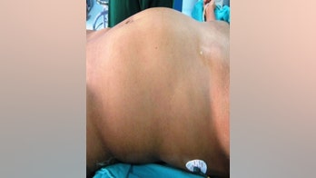 Teen's abdominal mass was malformed twin in extremely rare occurrence, case report says