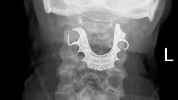 Man undergoes emergency surgery after dentures found lodged in throat days following procedure