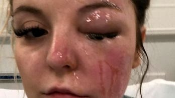 UK woman suffers facial burns after eggs 'exploded' in her face: 'It felt like my skin was being ripped off'
