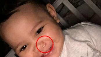 Woman claims C-section complication caused daughter’s facial scar: 'I worry what the future may hold for her'