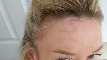 Woman left with 'Harry Potter' scar after skin cancer removed from forehead