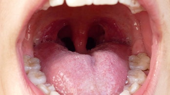 What are tonsil stones — and how do you know if you have them?