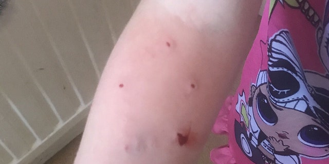 Gruesome Cat Bite Infection Sends Girl 6 To Operating Table Fox News