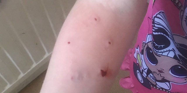 Four out of five puncture wounds became infected due to a bacteria found in the mouths of cats and dogs.