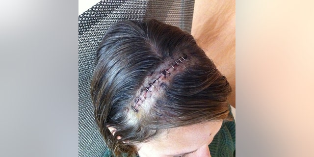 Wendi Lou Lee after brain surgery.