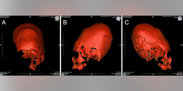 CT scan of the elongated skull.