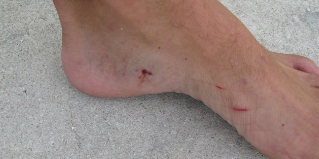 The man suffered bites to his foot and a scratched leg.