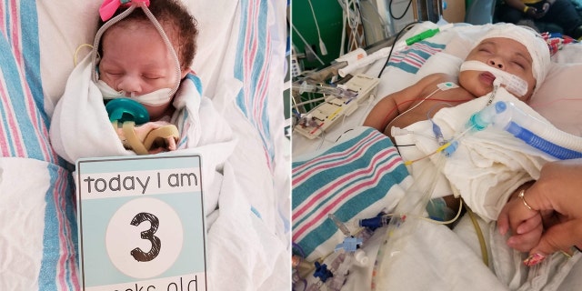 Phoenix Da'Vine, who is set to turn 1 on August 25, was born with a major heart defect known as Double Outlet Right Ventricle.