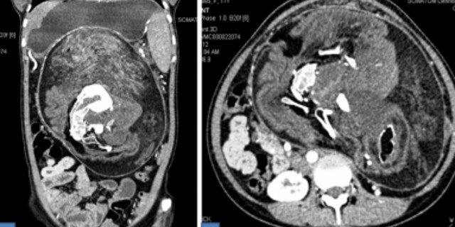 Scans revealed the mass had fat density areas, soft tissue and calcified density components.
