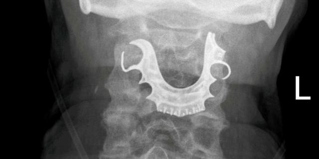 An X-ray of a patient who was left with his dentures in his throat after surgery.
