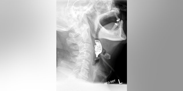 The man said he could not swallow solid food following his initial operation.