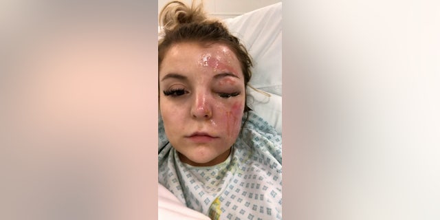 "I'm not sure if I will be able to see out of that eye when the swelling goes down." (SWNS)