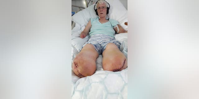 Mandy Parkin is recovering from amputation. (SWNS)