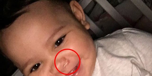 Amber Woollard's baby Valenci with the scar visible under her nose.