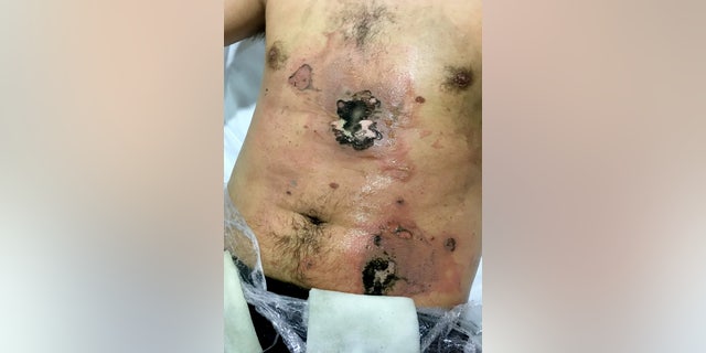 The man claims he told doctors he did not want a skin graft for his burns. (SWNS)