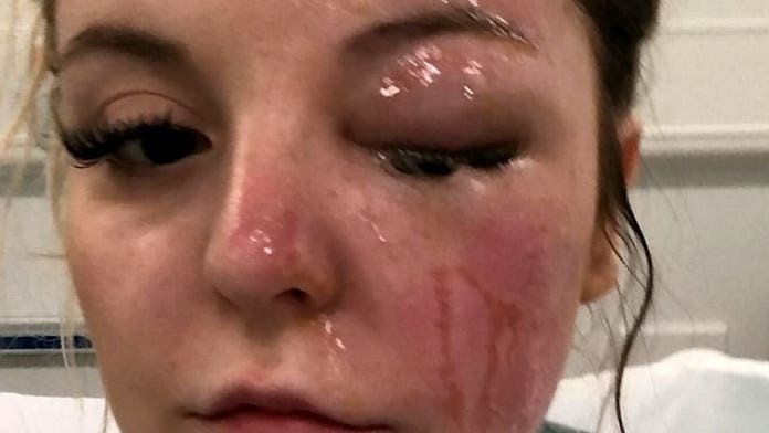 Uk Woman Suffers Burns After Eggs Exploded In Her Face Woman Suffers Burns After Eggs