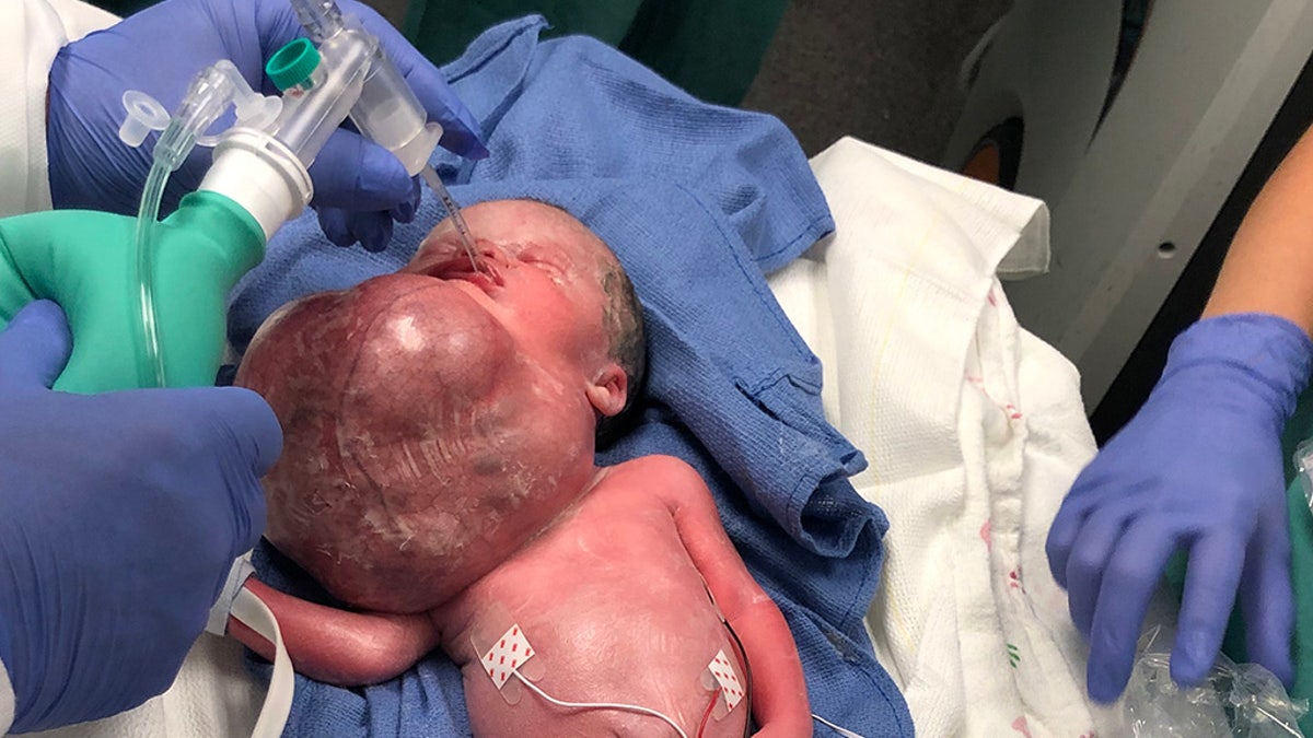 A team of 40 doctors oversaw her birth so they could take immediate action in removing the growth, which had doubled in size while she was in utero.