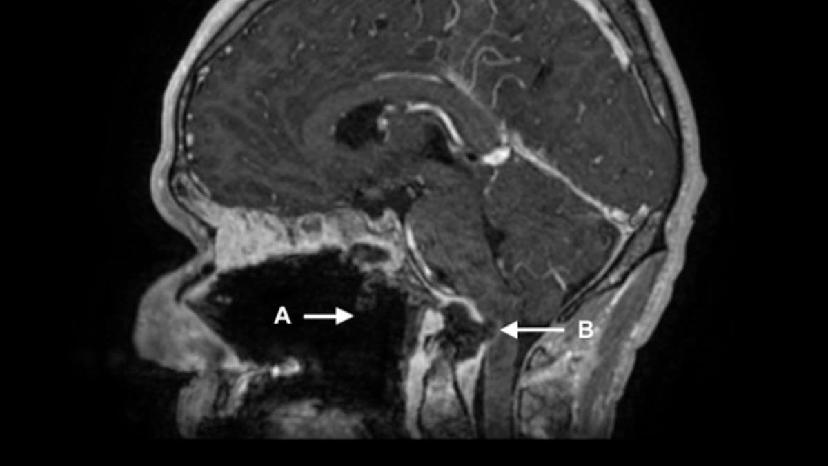 An MRI on his second visit, during which he was hospitalized with a suspected overdose, showed several brain issues in addition to the hole in this throat that was observed on his first visit. 