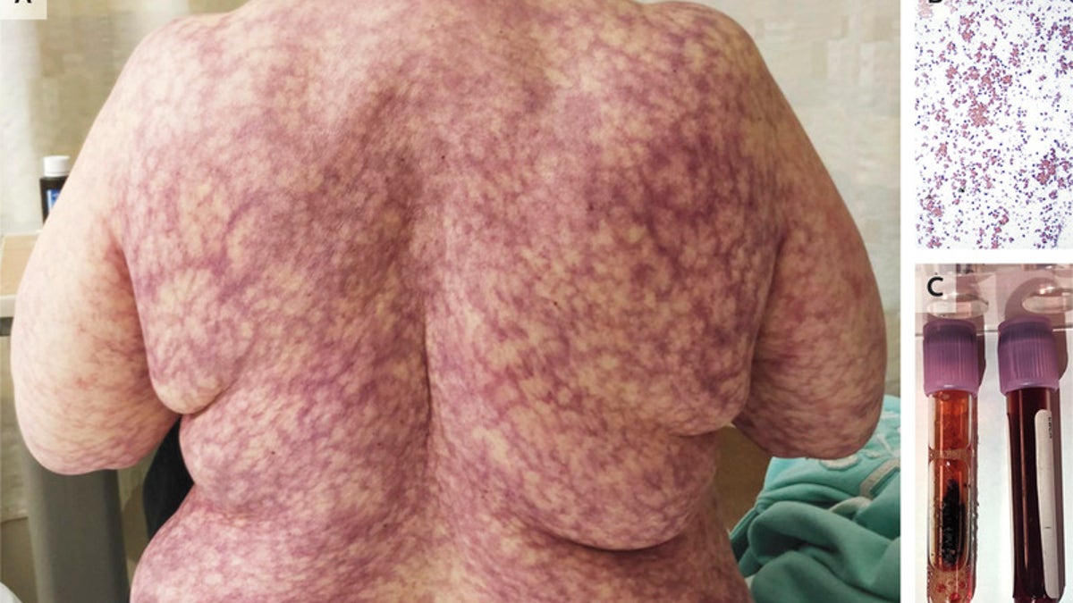 The 70-year-old woman was later diagnosed with cold agglutinin disease.