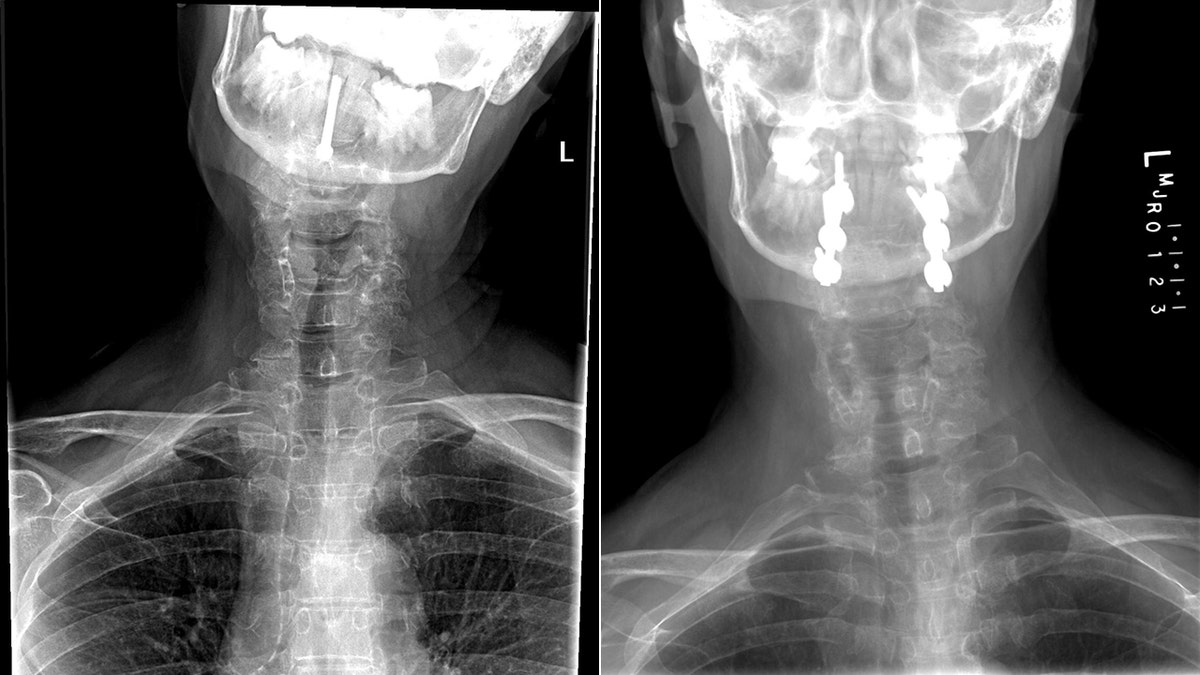 These X-rays show Bobeczko's crooked posture on the left, and the result of Lee's radical approach which involved re-breaking her neck and separating her skull from the rest of her body to realign it to the original position.