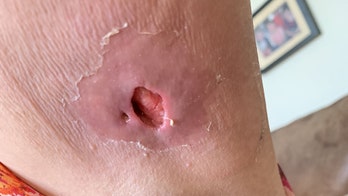 Spider bite leaves woman with gaping hole in armpit: 'It was absolute agony'
