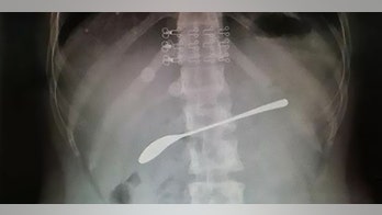 Drunk woman swallowed 6-inch spoon and forgot, report says