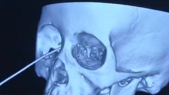 Pencil pierces girl's eye socket, narrowly misses her brain in terrifying injury: report