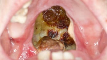 Cocaine burned massive hole in man's throat before untimely death: report