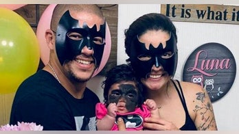 Florida toddler born with 'Batman' mask due to rare skin condition to seek treatment in Russia