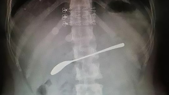 Drunk woman swallowed 6-inch spoon and forgot, report says