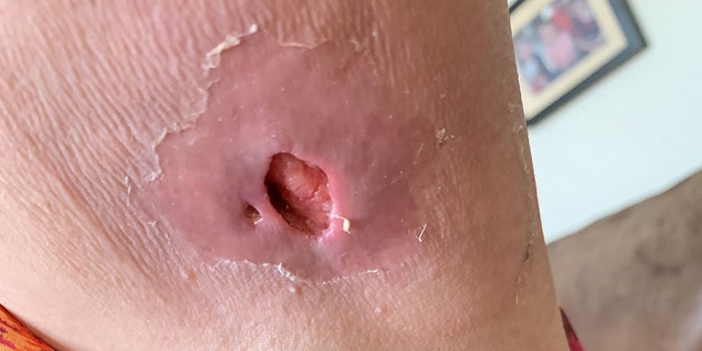 After several days of agonizing pain, she said doctors scooped out her infection and put her on antibiotics.