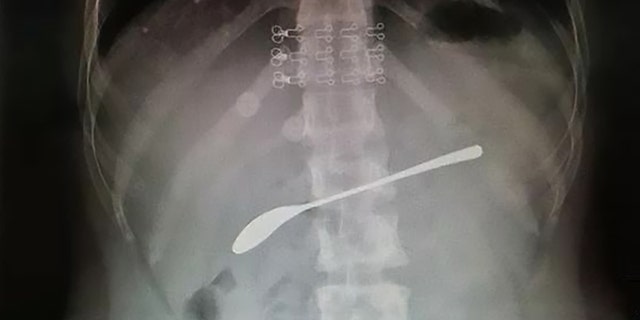 This X-ray shows a 6-inch steel spoon resting inside the stomach of a young woman who drunkenly swallowed it the night before and forgot about it until her stomach began hurting the next day.