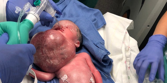 A team of 40 doctors oversaw her birth so they could take immediate action in removing the growth, which had doubled in size while she was in utero.