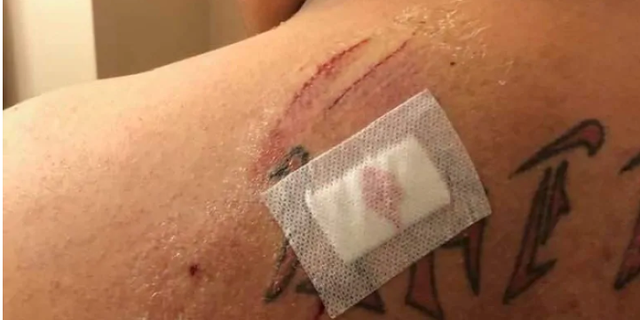 Brandon Lattie says he was attacked by a black bear at Ferguson Lake Nature Reserve in British Columbia, Canada.