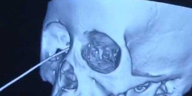 gardening These scans show a girl who was impaled in the eye by her own pencil after a classmate shoved her from behind while playing at school.