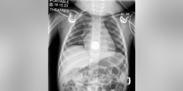 X-ray of Elsie-Rose, 2, showing the battery lodged in her esophagus. (SWNS)