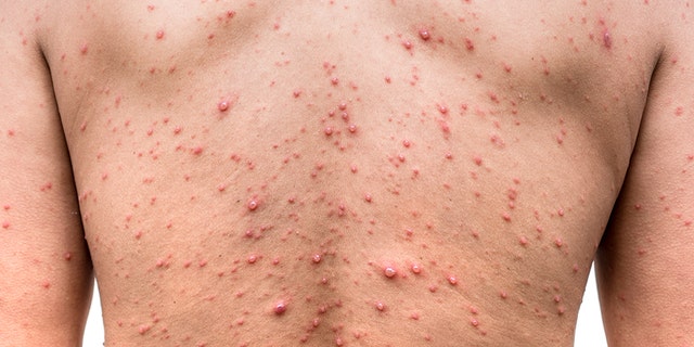 The outbreak occurred at a high school in eastern Michigan.