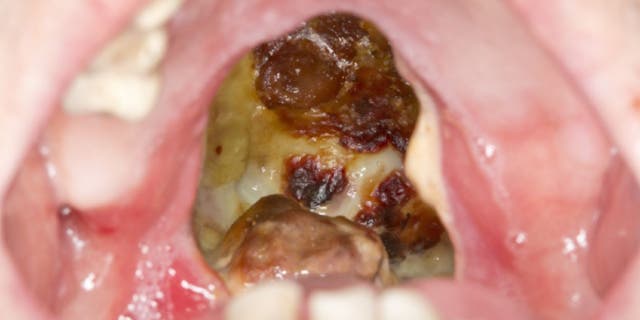 Doctors noted the erosion in his mouth on his first visit, which was confirmed by a CT scan.